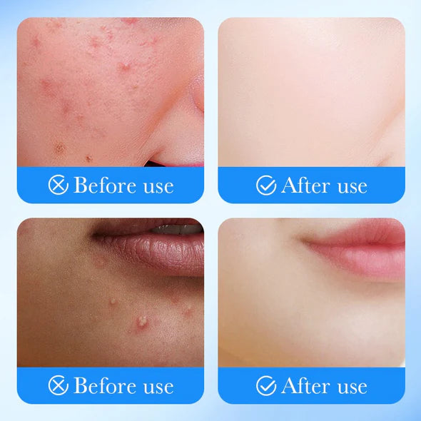 SADOER Acne Patch Invisible Protection