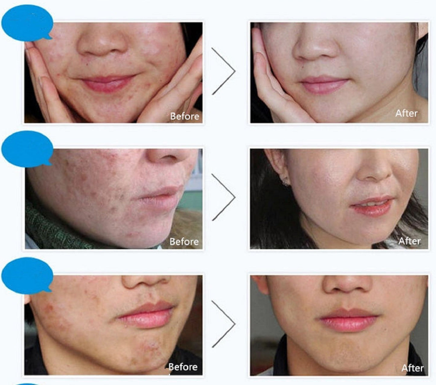 BIOAQUA Acne & Anti-Wrinkle Cream